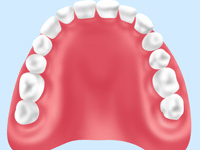 レジン床義歯(保険入れ歯)