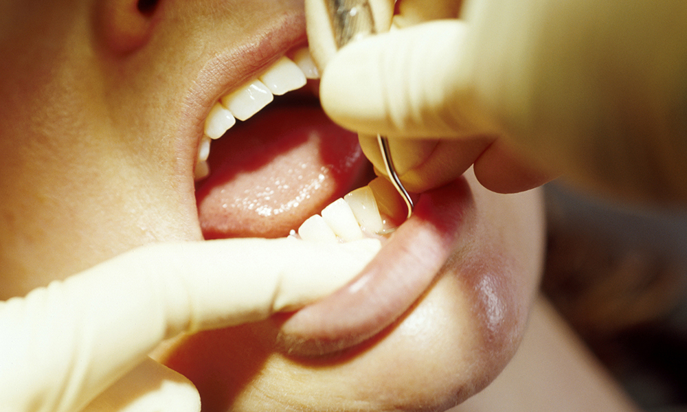 日本人の多くが悩まされる歯ぐきの病気
