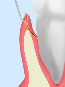 歯周ポケット掻爬(そうは)術