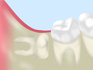 親知らずの抜歯