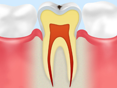 C0 ごく初期の 虫歯 