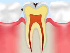 C1 エナメル質の 虫歯 