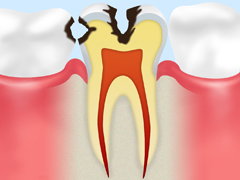 C2 象牙質の 虫歯 