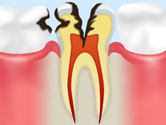 C3 神経に達した 虫歯 