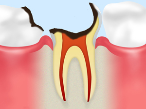 C4 歯根に達した 虫歯 