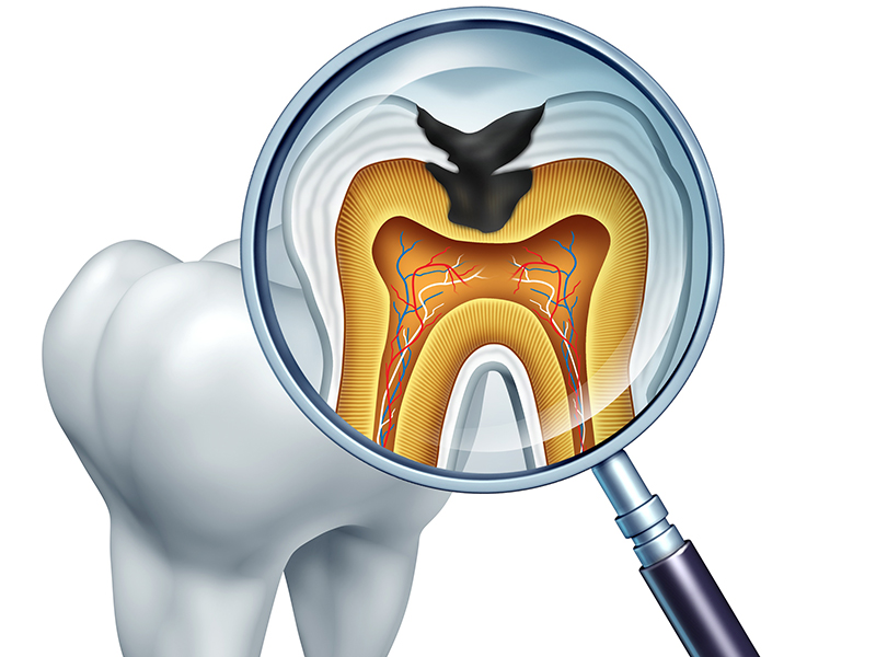 重度の虫歯は根管治療